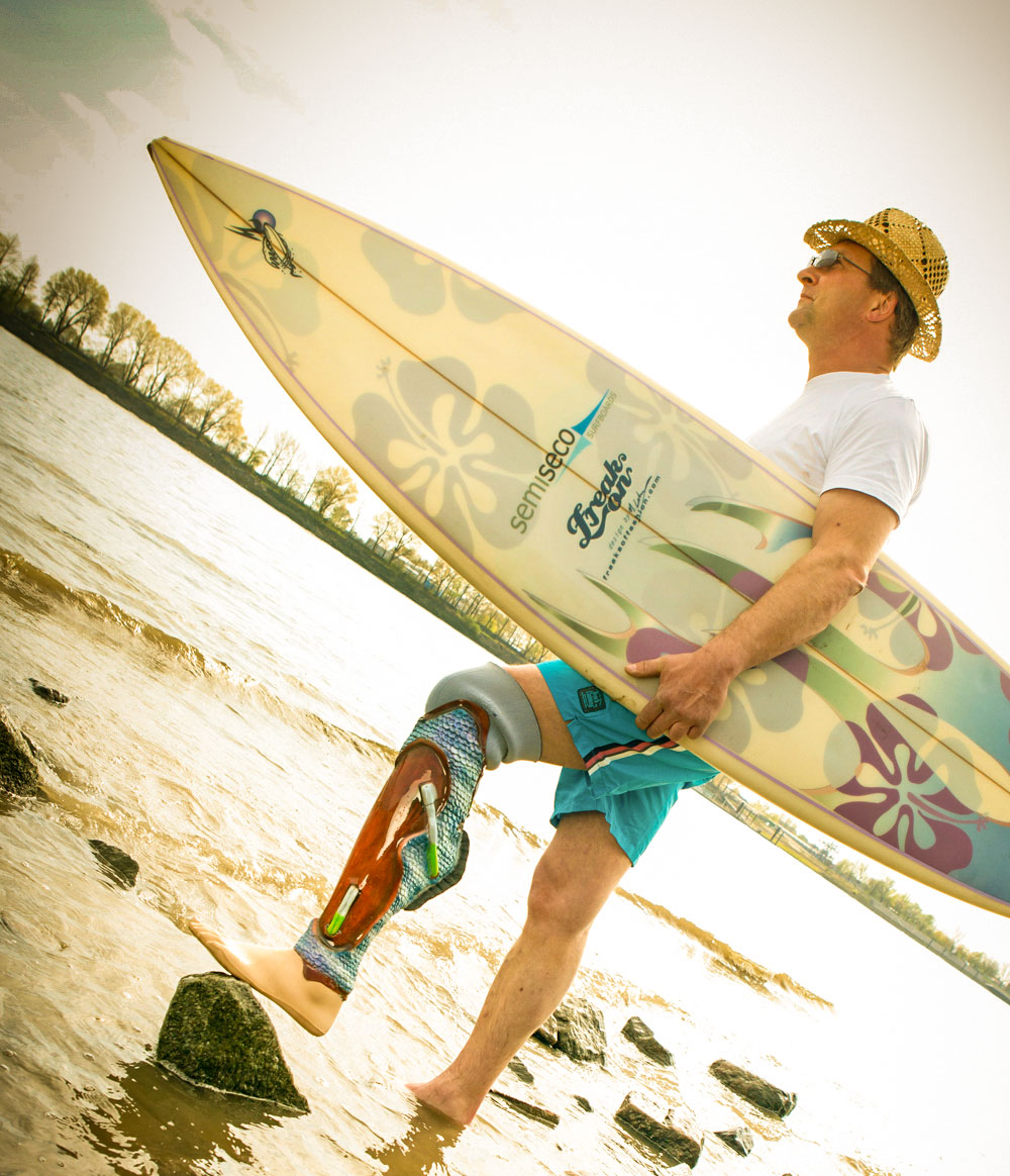Mann mit Unterschenkelprothese trägt Surfboard am Strand – aktiver Alltag und Sport mit Beinprothese